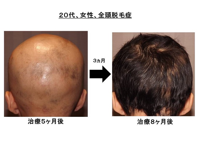 円形脱毛症　病院""